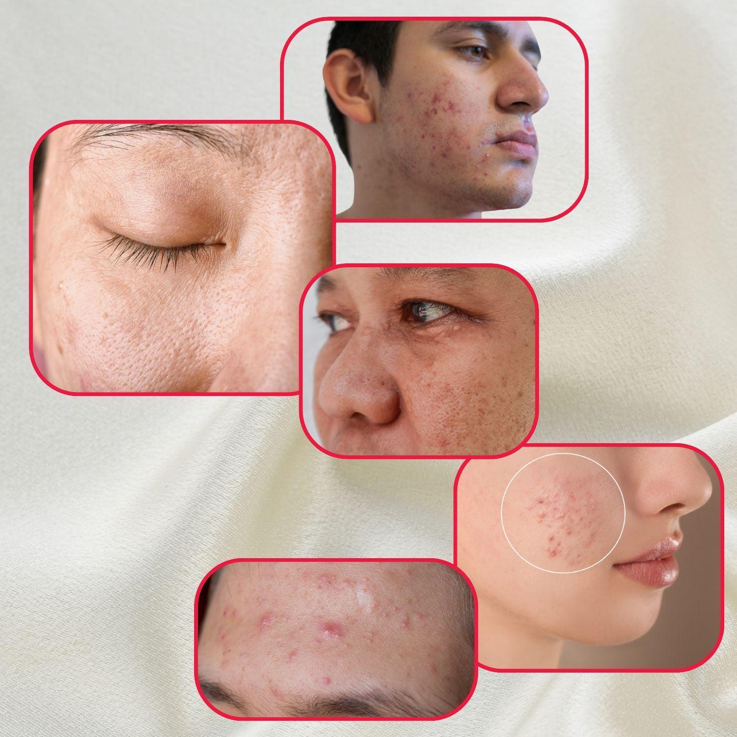 Perfect Trifecta Acne Peel by gymsegbë