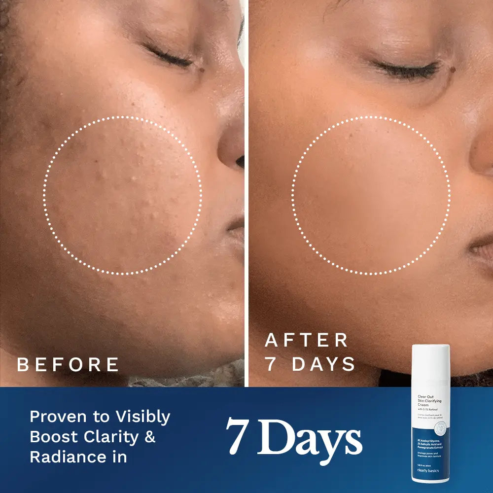 Clear Out Skin Clarifying Cream by Clearly Basics