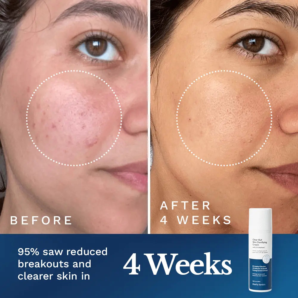 Clear Out Skin Clarifying Cream by Clearly Basics