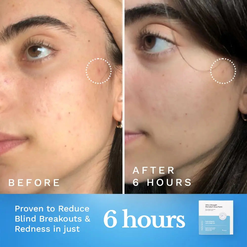Ultra-Strength Microdart Acne Patch by Clearly Basics