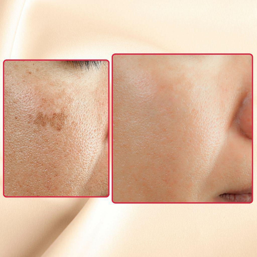 The Eraser Spot Cream | Dark Spot Corrector by gymsegbë