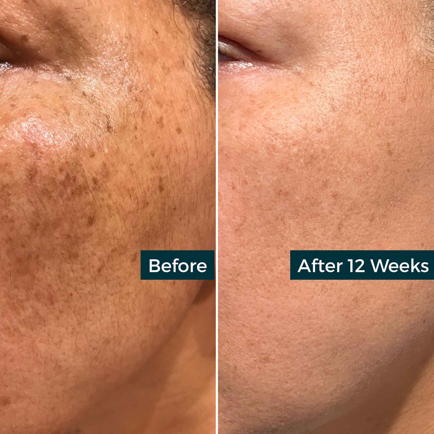 Before and after: Acne &amp; Blemish Care delivers clearer skin with reduced blemishes after 12 weeks.