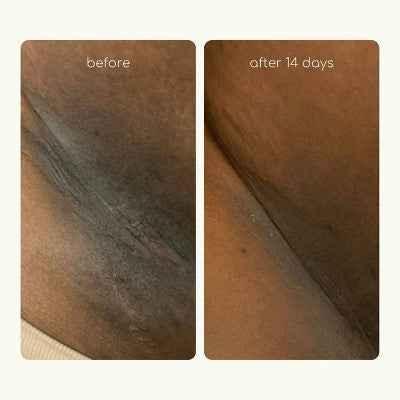 Underarm Care - DestGlow
