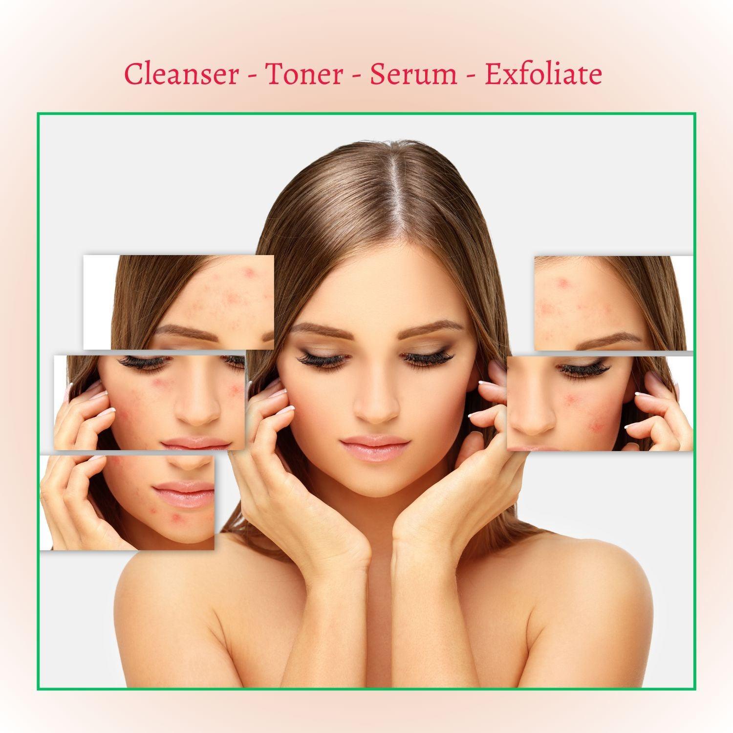 New Skin Natural Intensive Acne Serum by gymsegbë