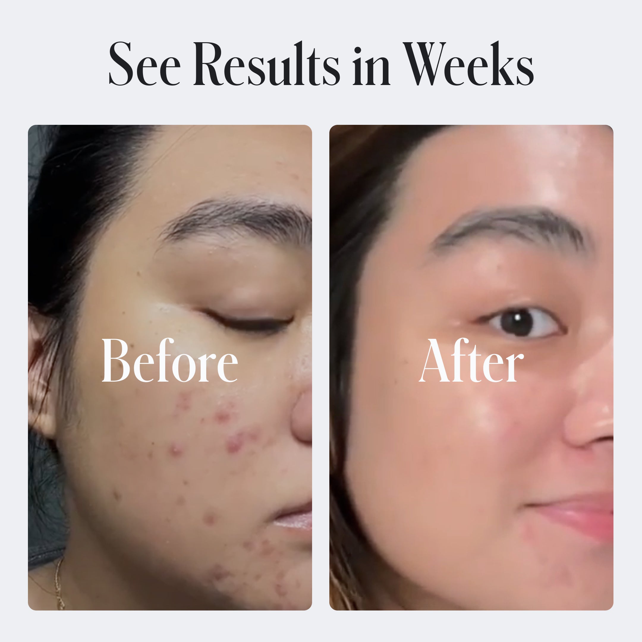 Acne Control Body Wash by Geologie