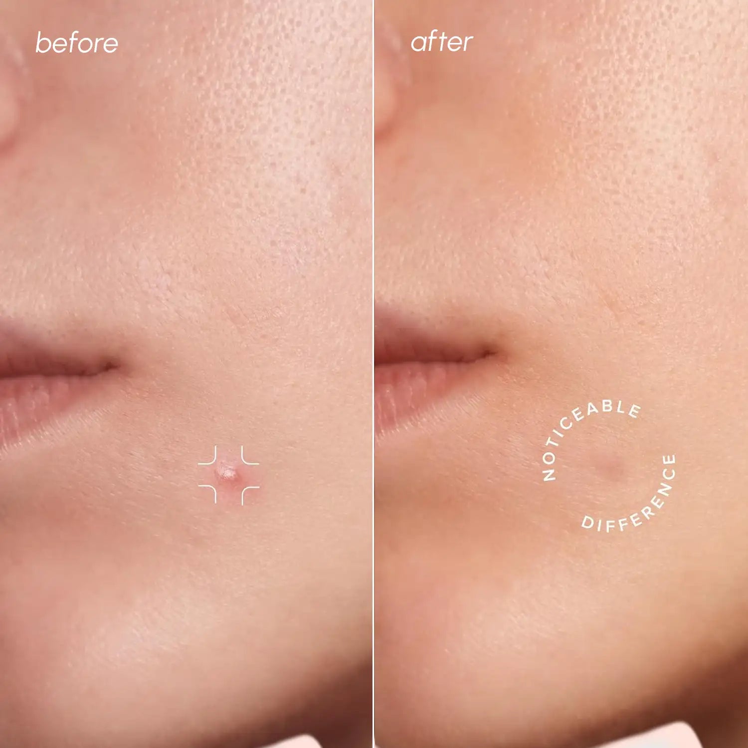 Invisible Pimple &amp; Acne Patches by Maree