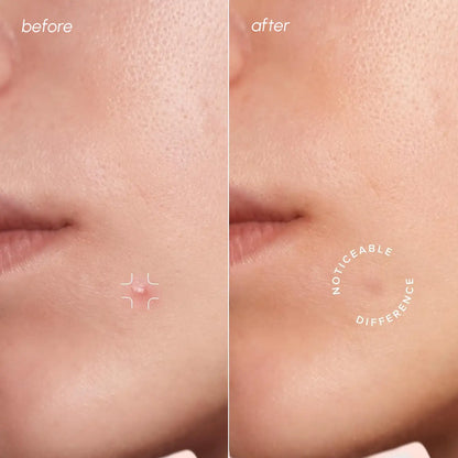 Invisible Pimple &amp; Acne Patches by Maree