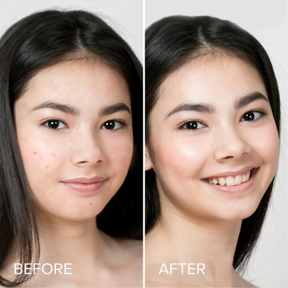 Pimple &amp; Acne Patches by Maree