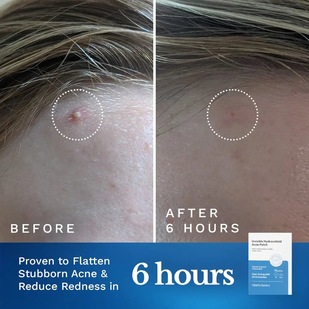 Invisible Acne Patch by Clearly Basics