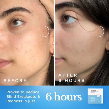 Ultra-Strength Microdart Acne Patch by Clearly Basics
