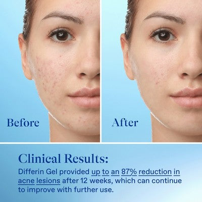 Differin Retinoid Acne Treatment; Adapalene Gel 0.1% 45g/1.6oz - New by This is Beauty US