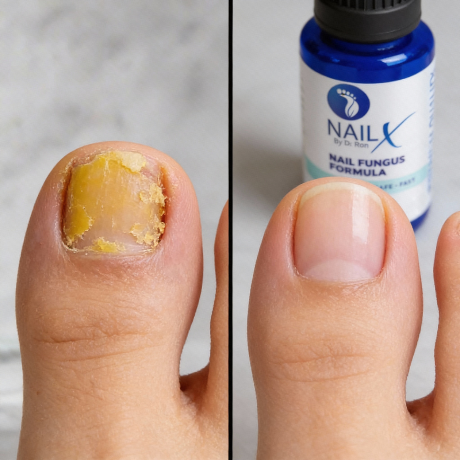 NailX Topical Nail Solution – Repair for Discolored, Damaged &amp; Fungal-Prone Nails by Foot Butter by Dr Ron